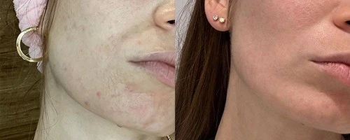 Авторский курс процедур – фотоомоложение и пилинги
