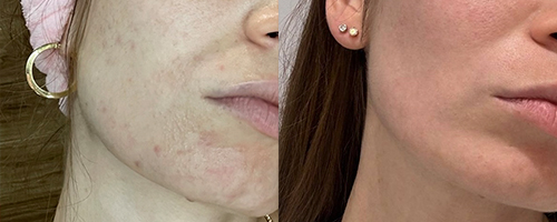 Авторский курс процедур – фотоомоложение и пилинги