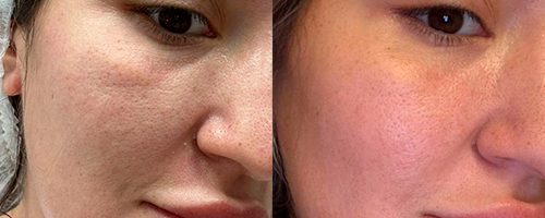 РФ-лифтинг Морфеус 8