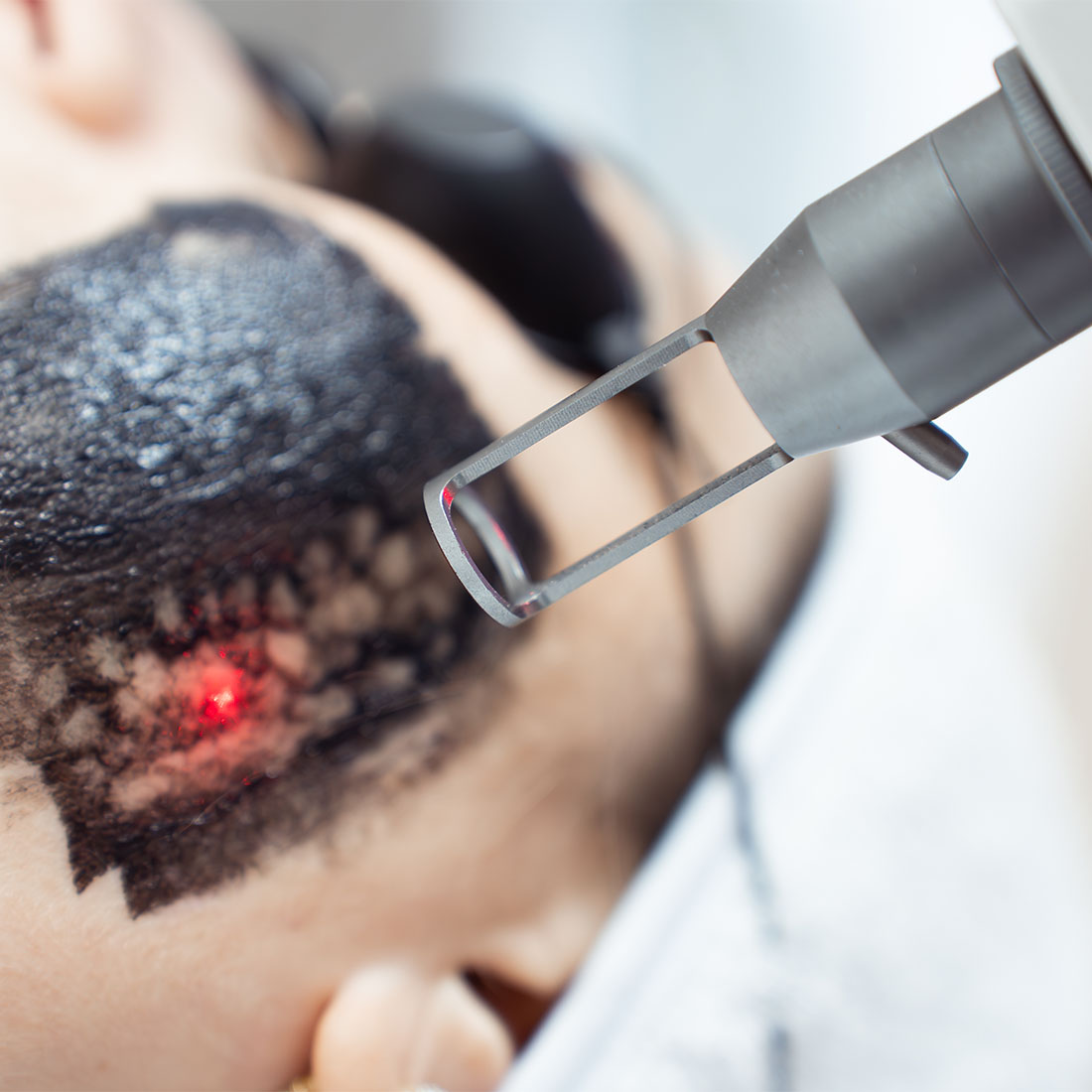 Карбоновый пилинг