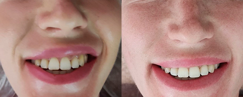 Массаж лица – исправление асимметрии улыбки