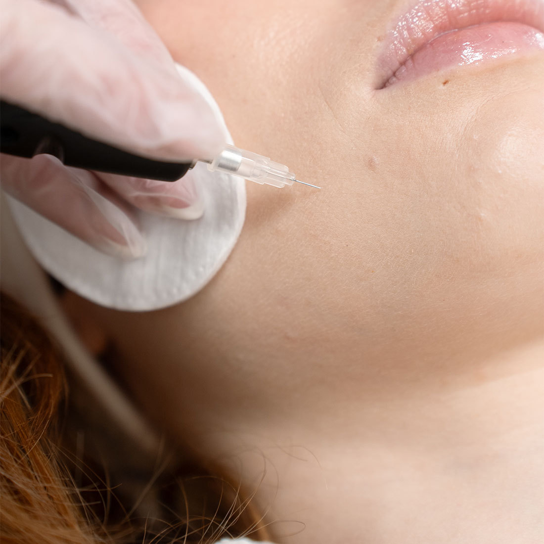 Карбокситерапия для лица