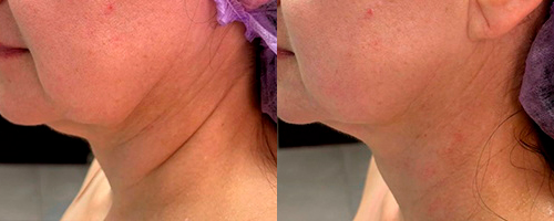 СМАС-лифтинг Ультраформер 3