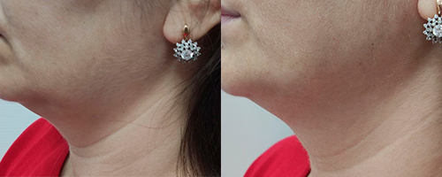 Лифтинг массаж