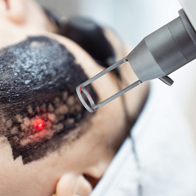 Карбоновый пилинг