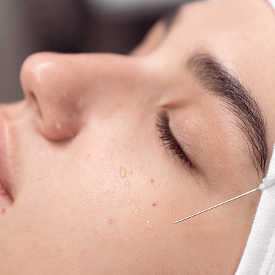 Срединный пилинг