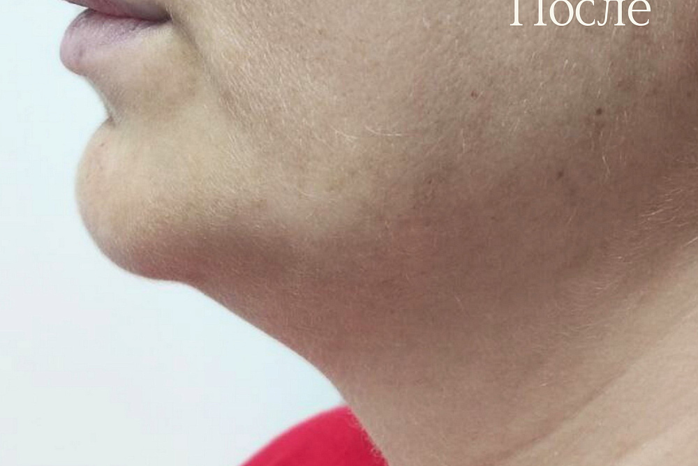 Лифтинг массаж